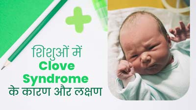 शिशुओं में रीढ़ की हड्डी और किडनी की समस्या का कारण हो सकता है Clove Syndrome, जानें इसके कारण और लक्षण