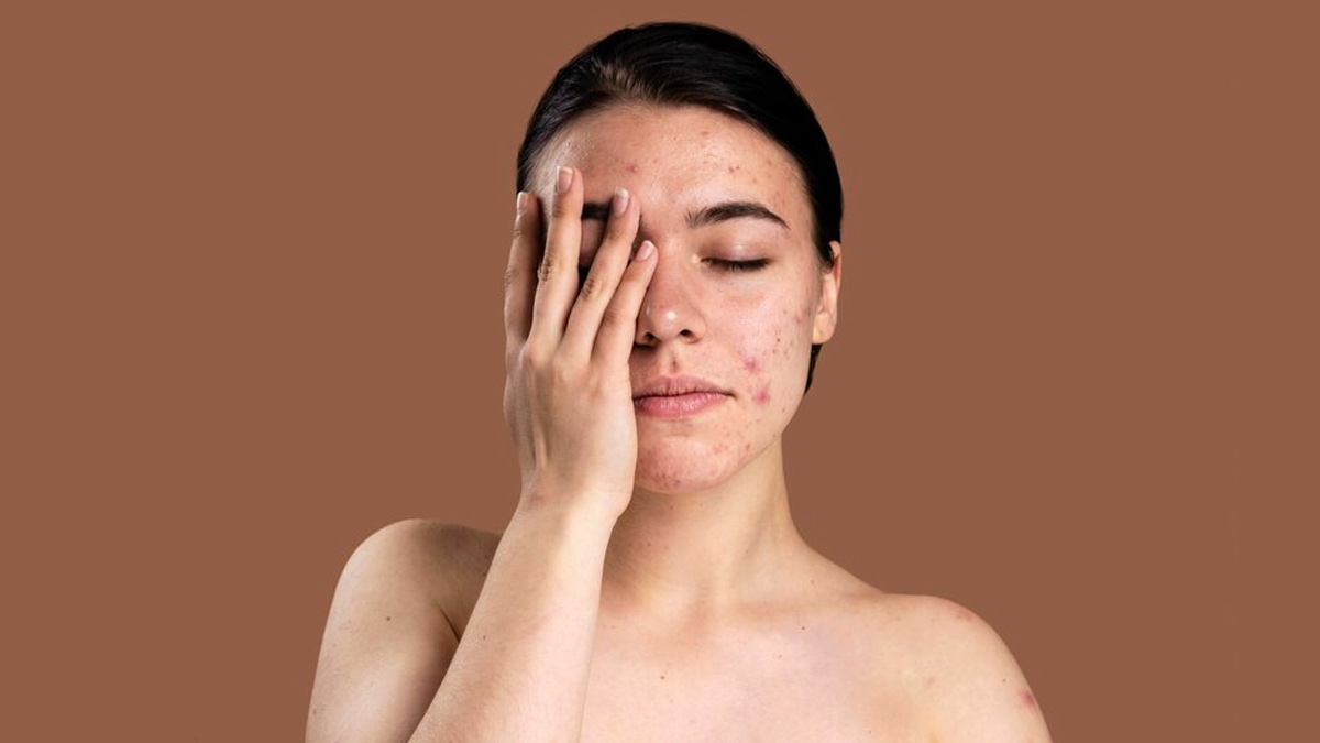 Are Your Bed Sheets And Pillow Covers Causing Acne Ways To Prevent Acne Due To Bedding OnlyMyHealth