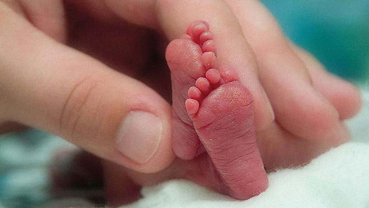 bone health in premature babies