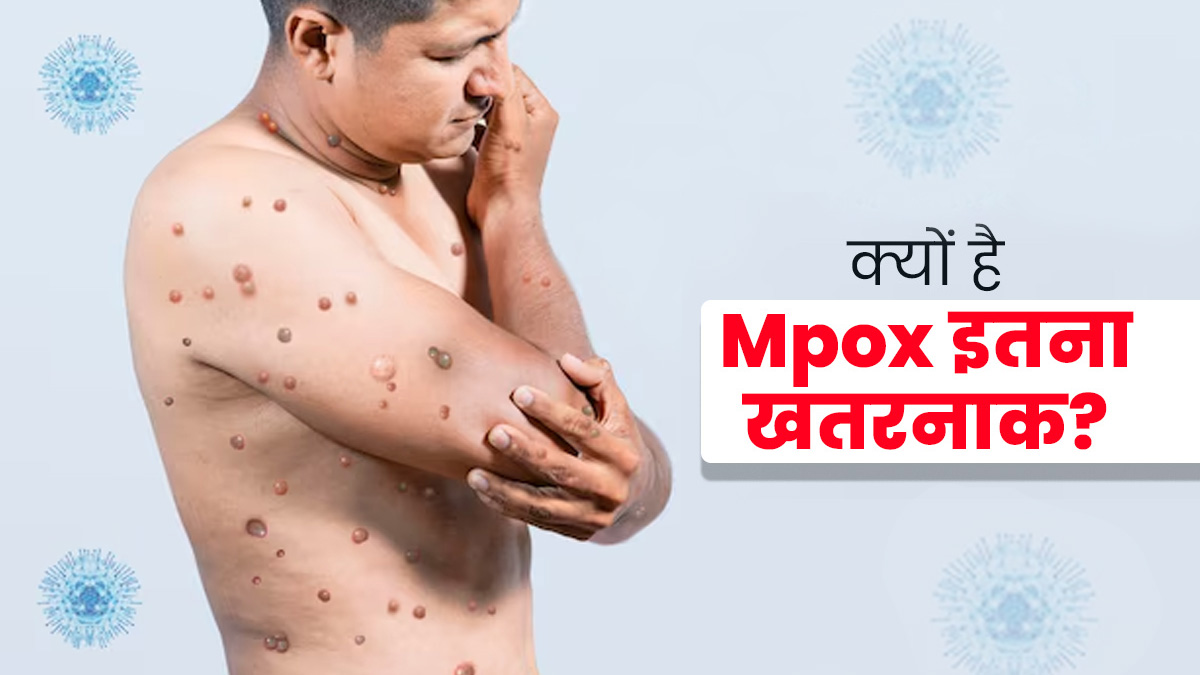 Mpox Outbreak: क्यों है Mpox इतना खतरनाक? जानें इस बीमारी की हिस्ट्री और बचाव के तरीके