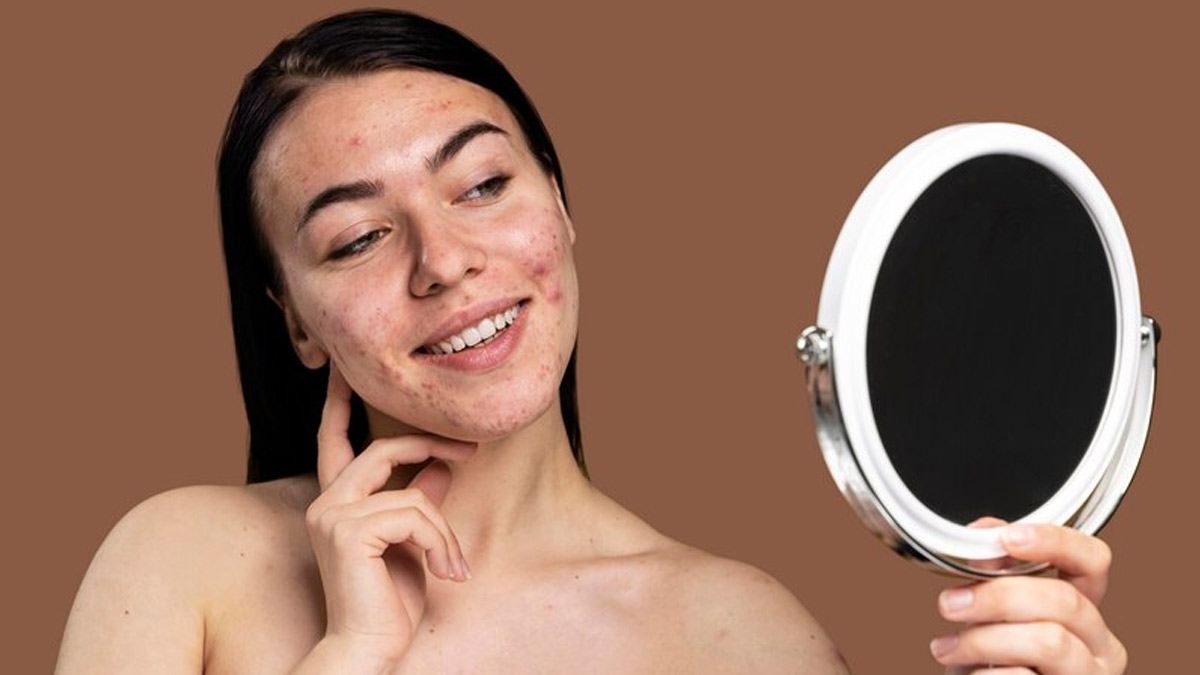 Acne Prone Skin से छुटकारा पाने के लिए एक्सपर्ट ने फॉलो की ये 7 चीजें, आप भी कर सकते हैं ट्राई