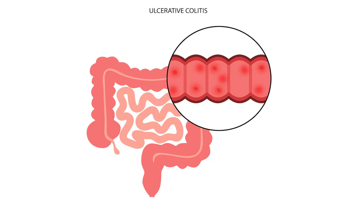 ulcerative colitis complications 