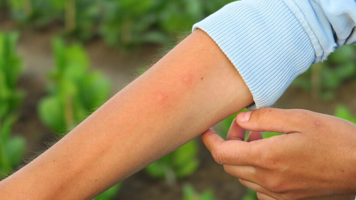 mosquito-bite-allergy