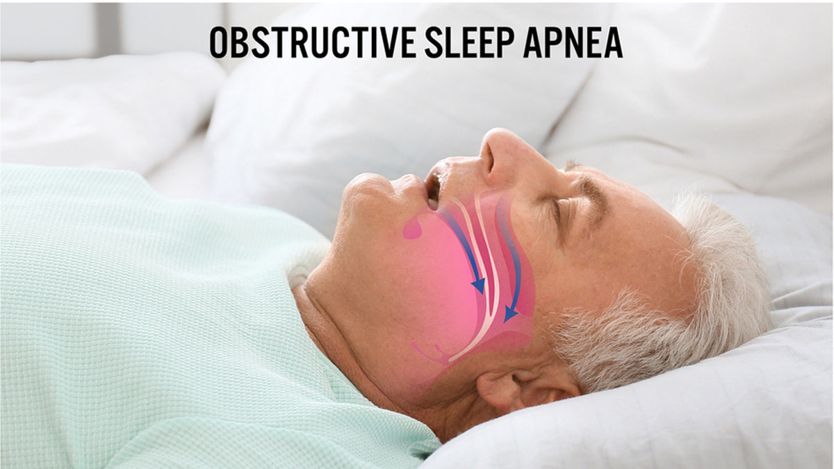 obstructive-sleep-apnea
