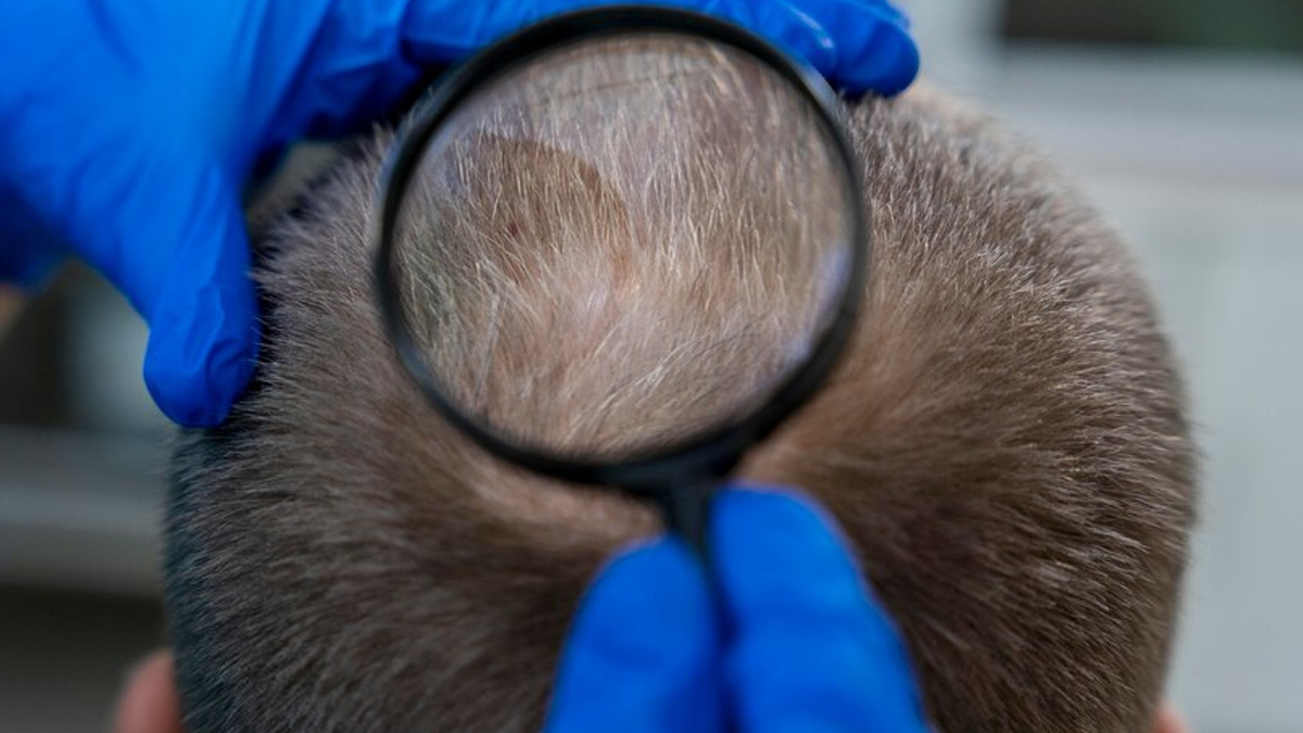hair-loss-test