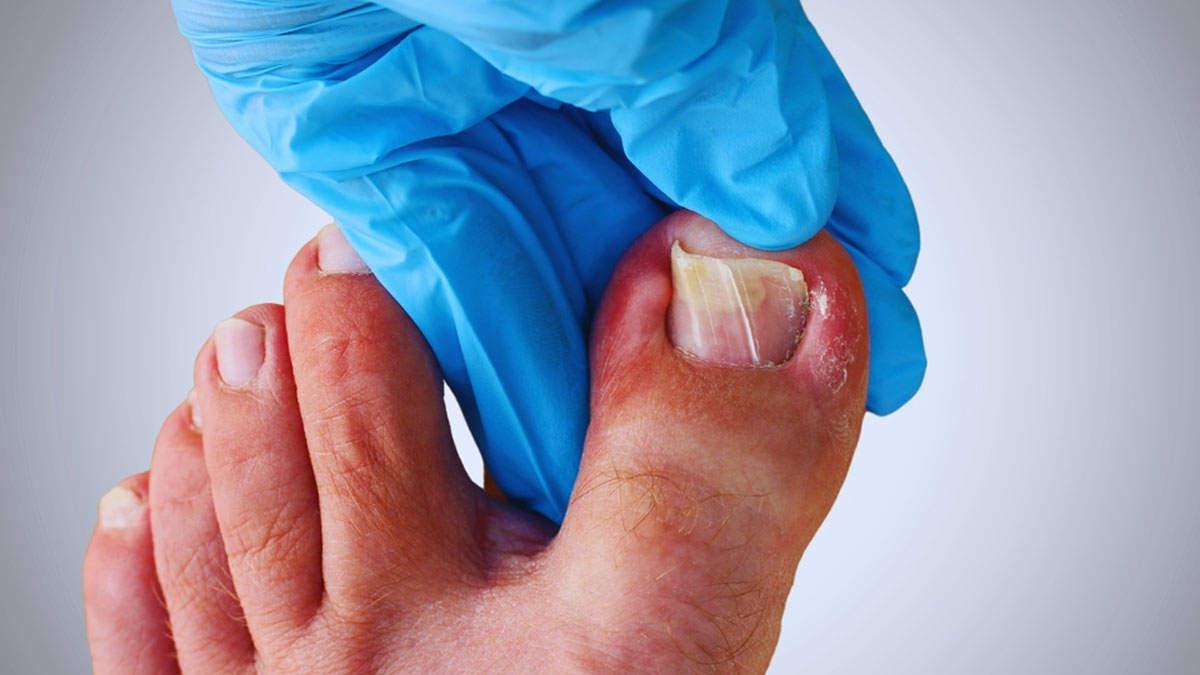 Nail Care For Diabetics: Follow These Tips To Maintain Healthy Feet and Hands