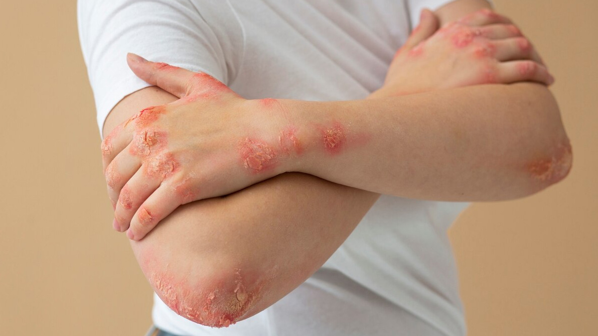 scabies in hindi 