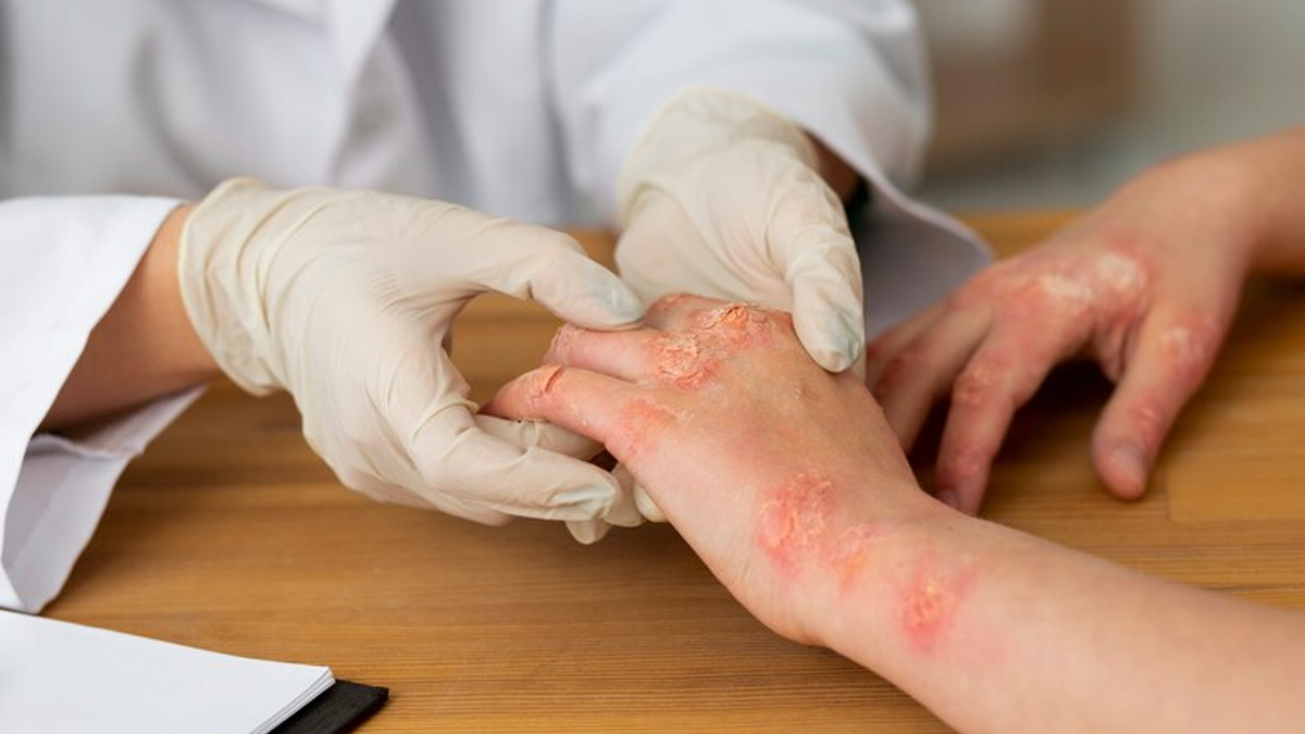 turmeric for skin eczema