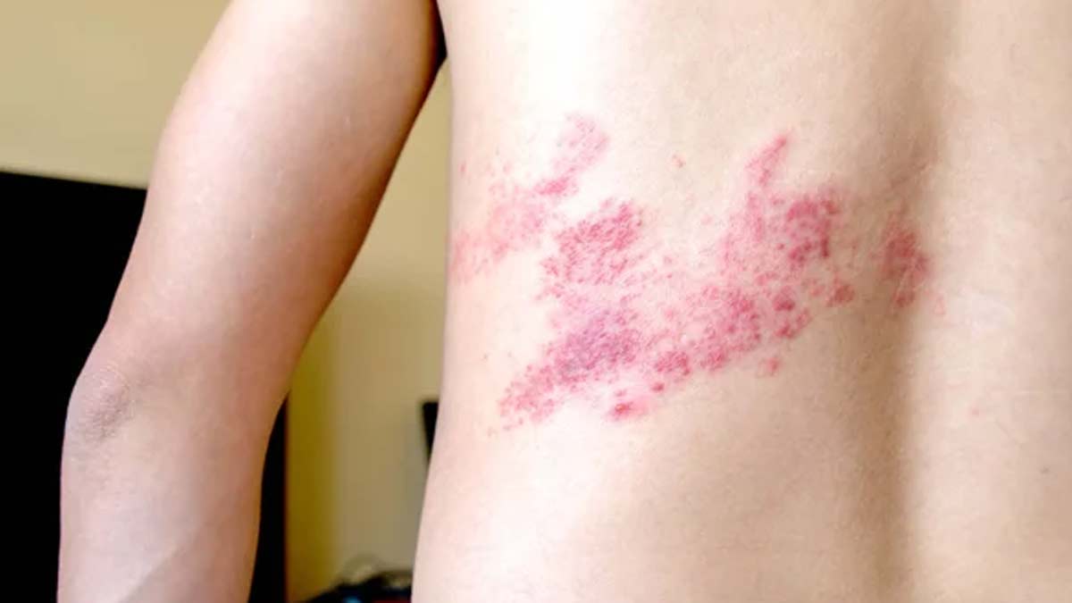 shingles and diabetes