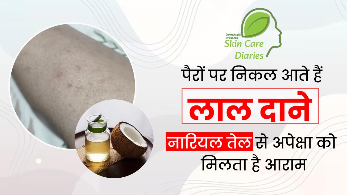 पैरों पर अक्सर निकल आते हैं लाल दाने, राहत पाने के लिए अपेक्षा लगाती हैं नारियल तेल, जानें इस समस्या के कारण