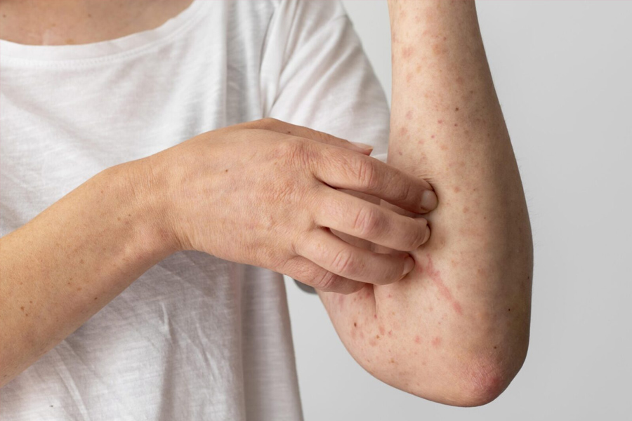 chickenpox and shingles 