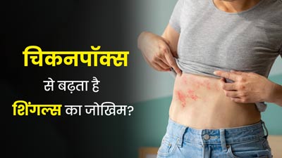 क्या चिकनपॉक्स से बढ़ता है शिंगल्स (त्वचा पर लाल चकत्ते) का जोखिम? डॉक्टर से समझें दोनों के बीच संबंध