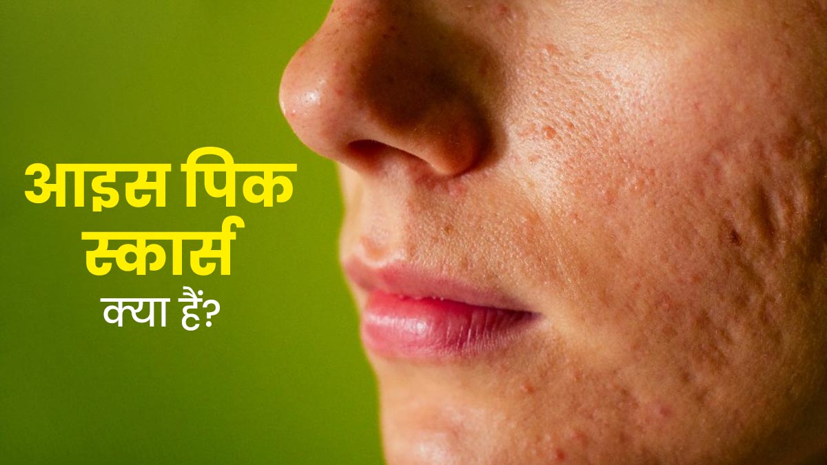 चेहरे पर नजर आने वाले आइस पिक स्कार्स क्या हैं? जानें मुहांसों के निशान मिटाने के लिए आसान तरीके