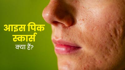चेहरे पर नजर आने वाले आइस पिक स्कार्स क्या हैं? जानें मुहांसों के निशान मिटाने के लिए आसान तरीके