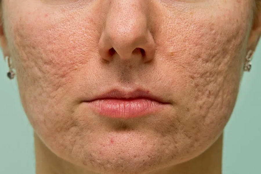 ice pick scars treatment