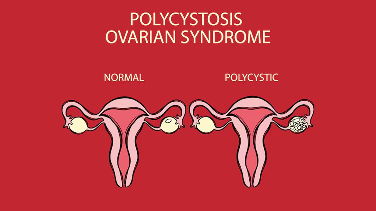 PCOS