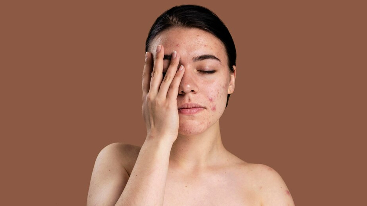 acne-skin