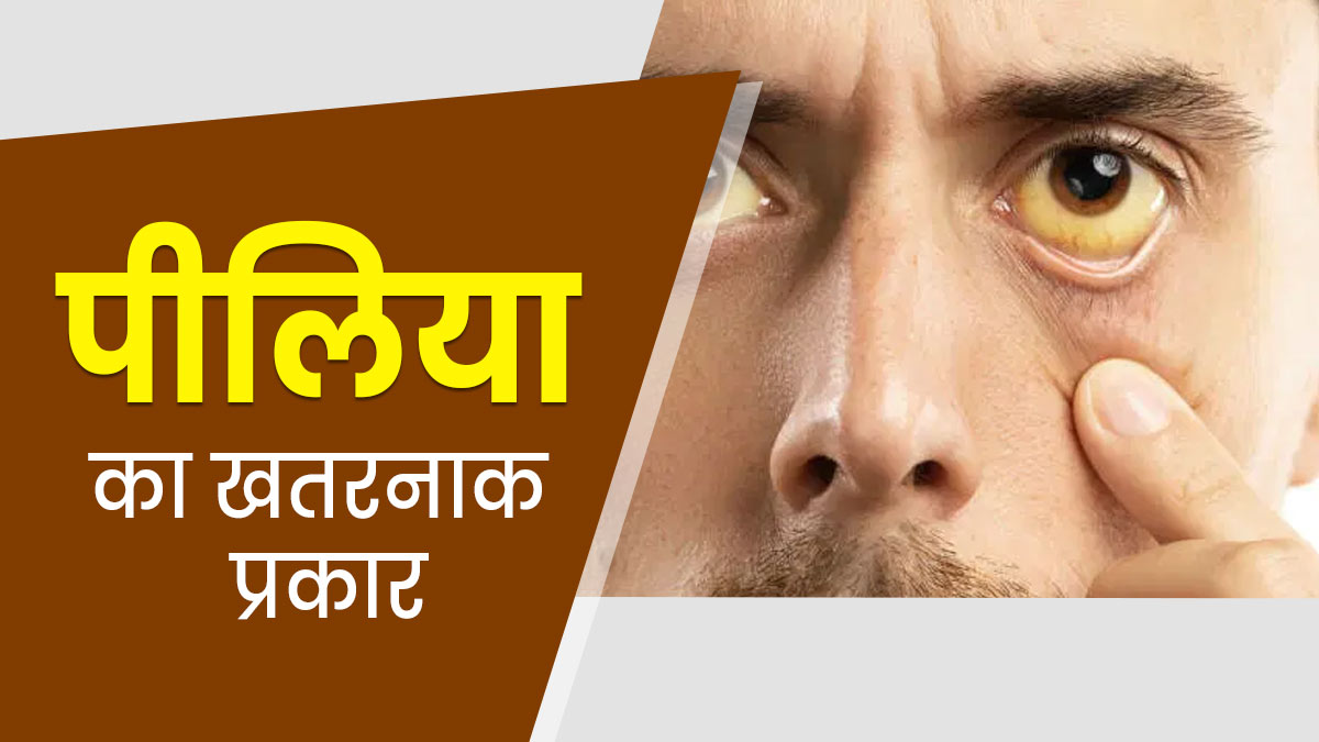 कौन-सा पीलिया सबसे ज्यादा खतरनाक होता है? एक्सपर्ट से जानें कैसे करें बचाव