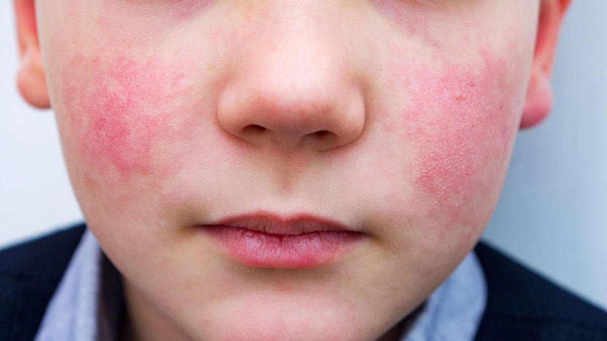 Parvovirus B19 On The Rise In The US; Know All About The Infection
