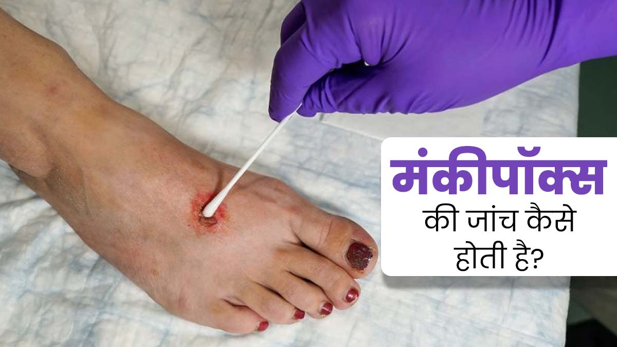 Monkeypox Virus: फ्लू जैसे दिखते हैं मंकीपॉक्‍स के लक्षण, जानें क‍िस जांच से होती है पुष्टि