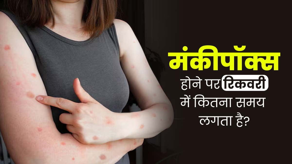 Mpox Virus in India: मंकीपॉक्‍स से र‍िकवर होने में क‍ितना समय लगता है? डॉक्टर से जानें