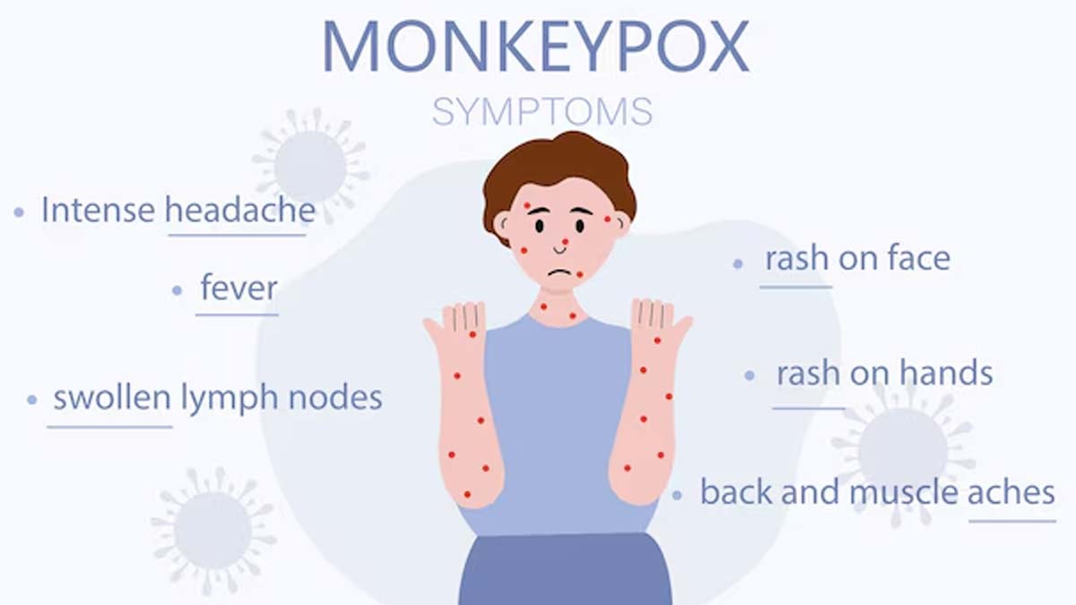 monkeypox symptoms 