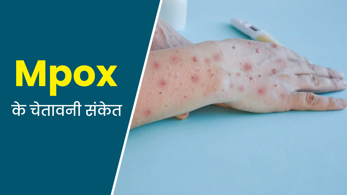 Mpox Early Signs: तेजी से फैल रहा Mpox, इन 5 शुरुआती चेतावनी संकेतों को बिलकुल न करें नजरअंदाज