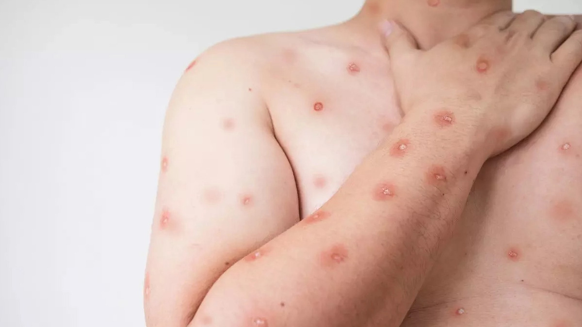 Mpox Outbreak: दुनियाभर में तेजी से फैल रहा है Mpox, कांगो में अबतक 570 से ज्यादा लोगों की हो चुकी है मौत 