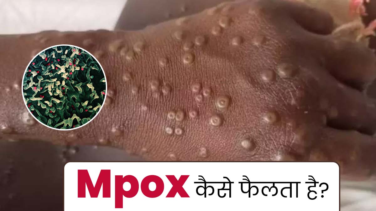 एक से दूसरे व्यक्ति में कैसे फैलता है Mpox? इस तरह से करें बचाव