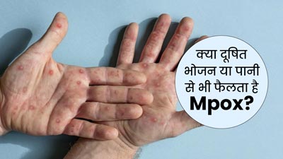 Monkeypox in Hindi: क्या दूषित भोजन या पानी से भी फैलता है Mpox वायरस? एक्सपर्ट से जानें