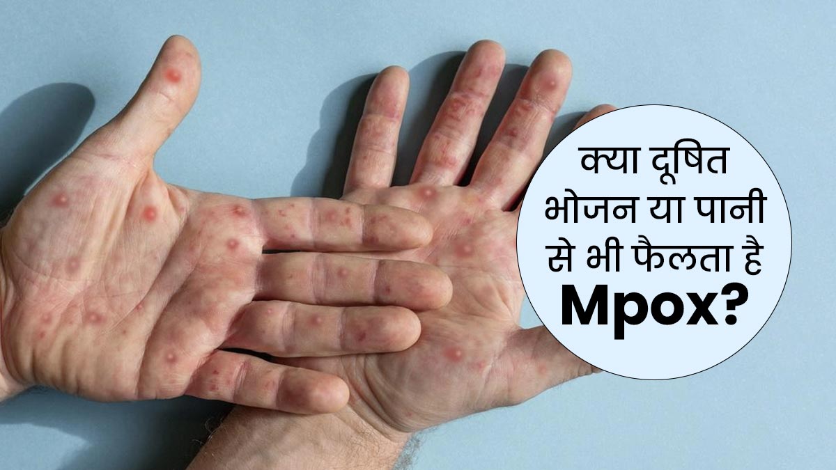 Monkeypox in Hindi: क्या दूषित भोजन या पानी से भी फैलता है Mpox वायरस? एक्सपर्ट से जानें