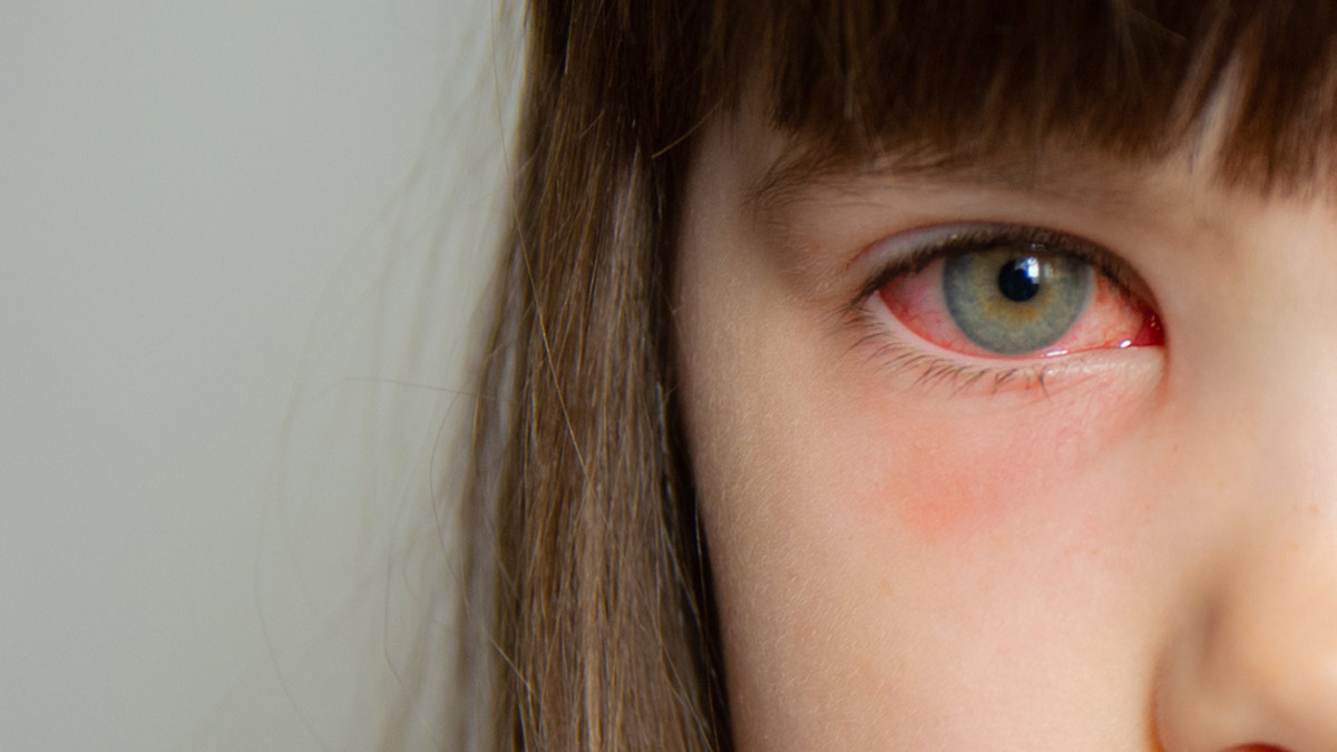 Why Are Children More Prone To Conjunctivitis During Monsoon