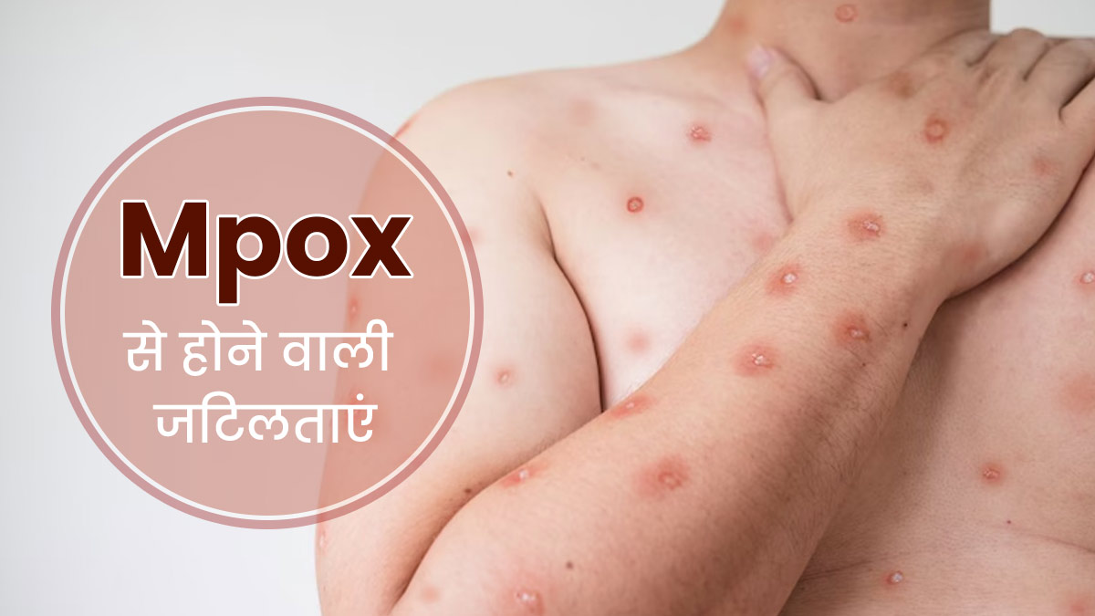 समय पर Mpox का इलाज न किया जाए तो बढ़ सकती हैं कई जटिलताएं, लक्षणों को न करें नजरअंदाज