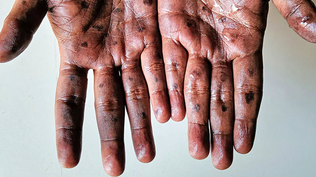monkeypox complications