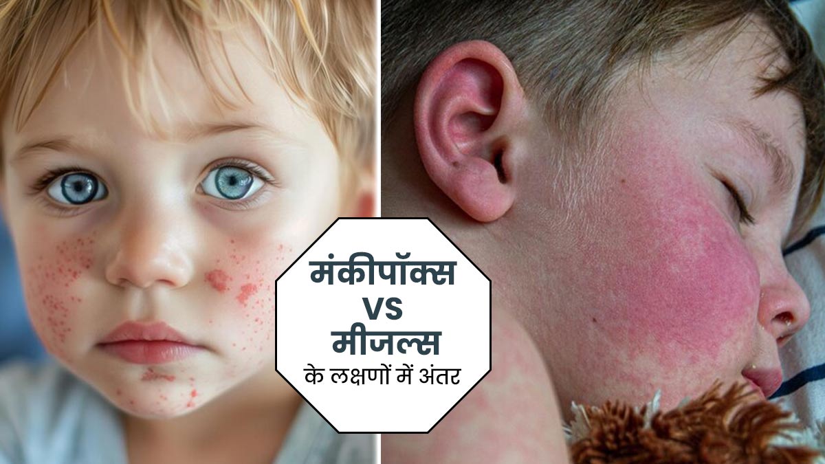 Mpox vs Measles: बच्‍चों को भी हो सकती हैं मंंकीपॉक्‍स और खसरा जैसी बीमार‍ियां, लक्षणों से समझें अंतर