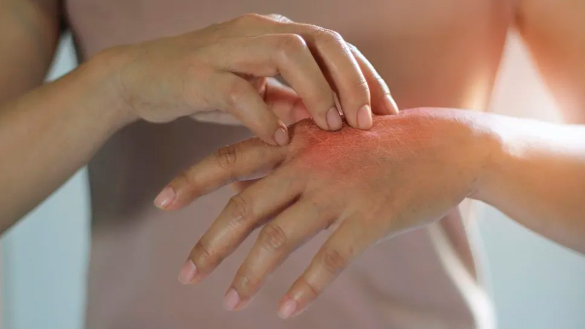 Progesterone Hypersensitivity