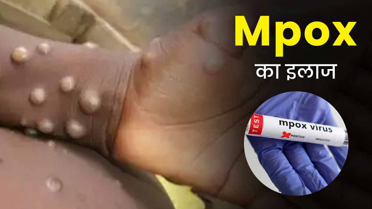 Mpox Treatment: मंकीपॉक्स का इलाज क्या है? जानें इसके ट्रीटमेंट ऑप्शन 