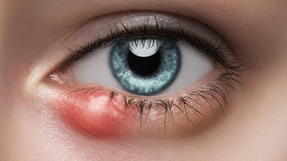 How To Protect Yourself From Stye During Monsoon?