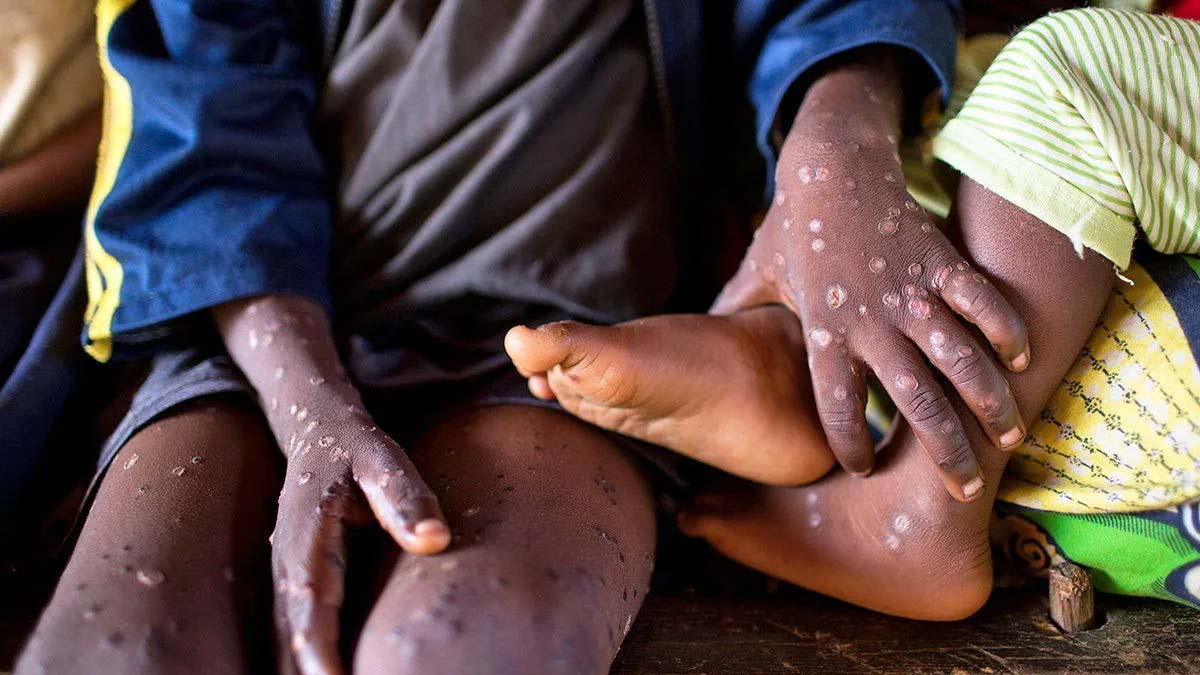Mpox Outbreak in Hindi: थाईलैंड में मिला एमपॉक्स का नया स्ट्रेन, एशिया में पहली बार सामने आया संक्रमण का मामला
