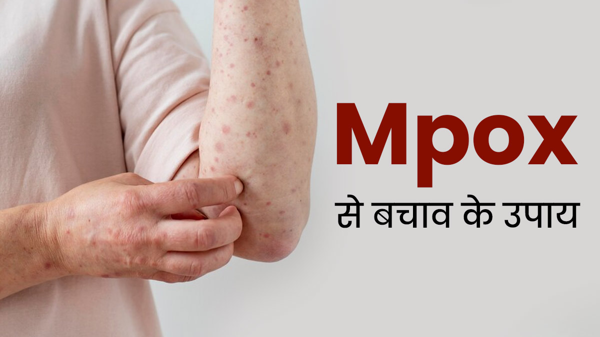 दुनियाभर में फैल रहा Mpox, बचाव के लिए अपनाएं ये 5 टिप्स