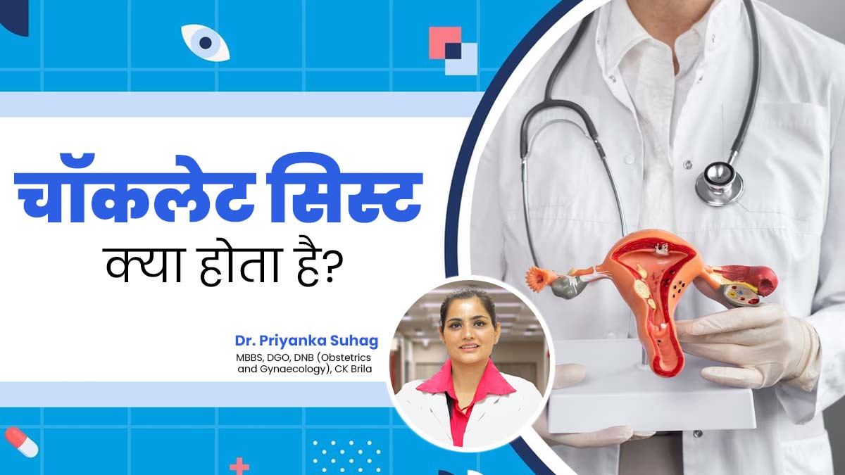 पीरियड्स में तेज दर्द हो सकता है चॉकलेट सिस्ट का संकेत, जानें ओवरी की इस समस्या के कारण और इलाज