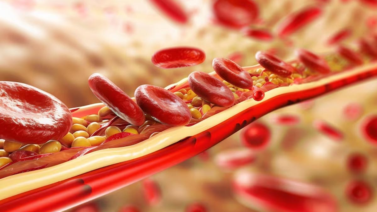 High Triglycerides Are Harmful For The Heart, But How Does It Impact Your Risk Of Diabetes?