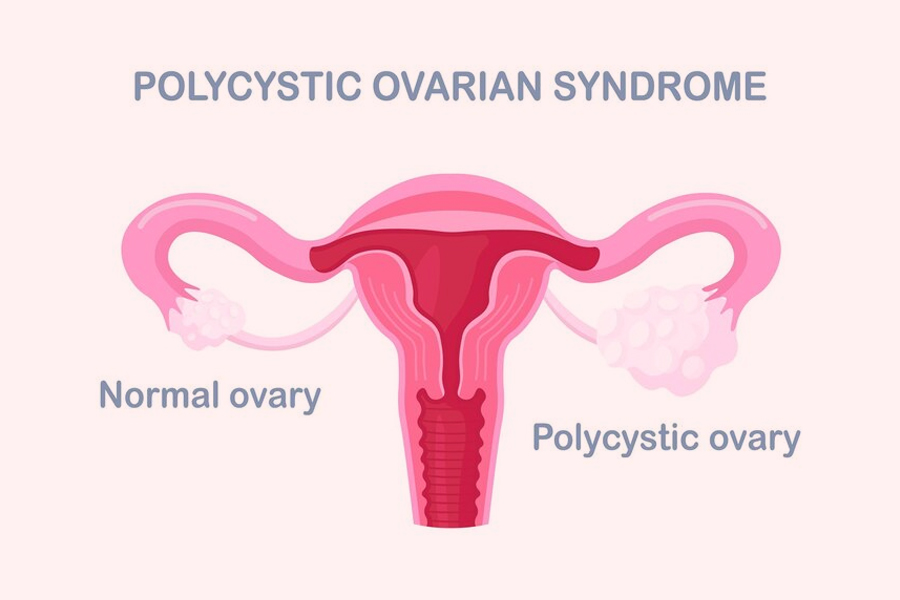 PCOS