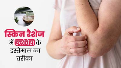 स्किन रैशेज होने पर इन 5 तरीकों से करें एलोवेरा का इस्तेमाल, मिलेगा आराम