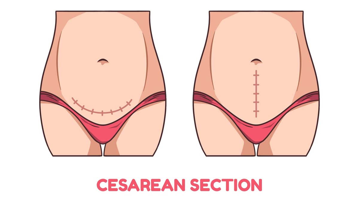 Causes Of Cesarean Section In Hindi