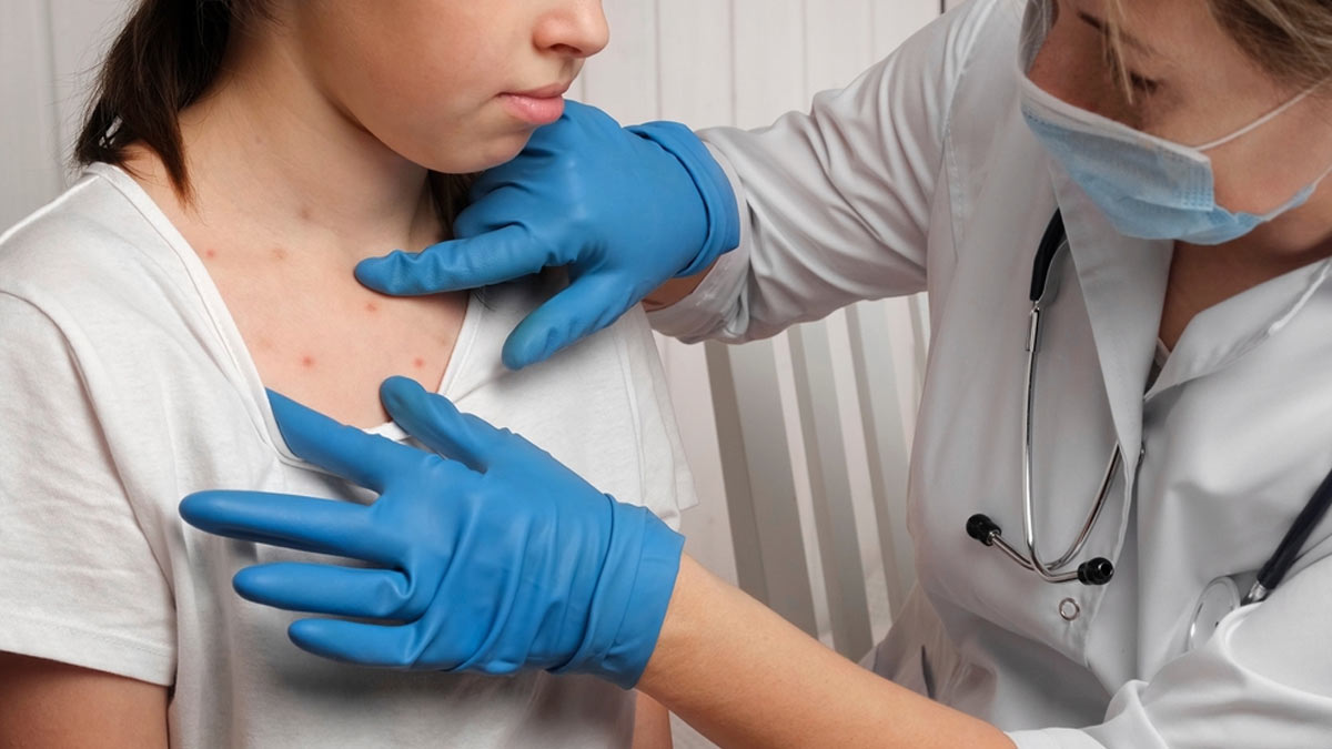 Why Are Children More Susceptible To Mpox? Doctor Insights