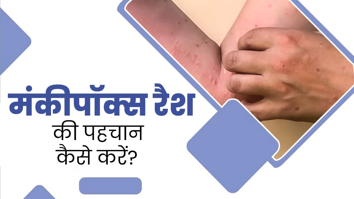 एक जैसे लग सकते हैं मंकीपॉक्स और दूसरे इंफेक्शन से होने वाले रैशेज, जानें कैसे पहचाने अंतर?