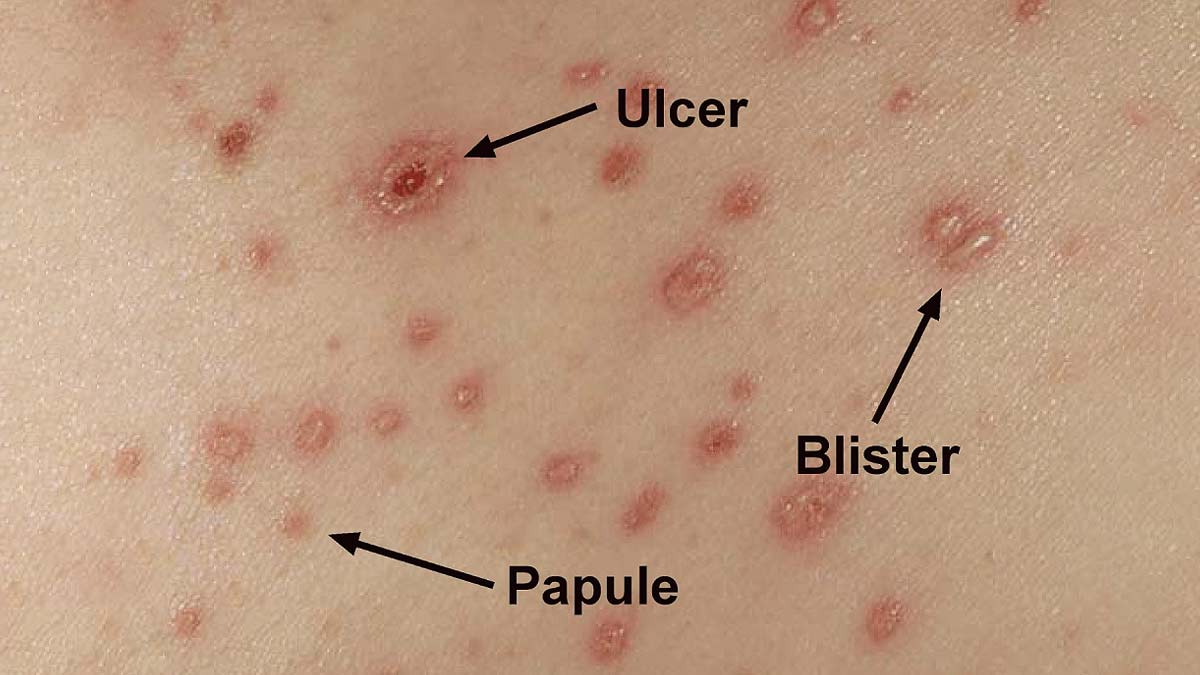 difference between normal rash and monkeypox rash