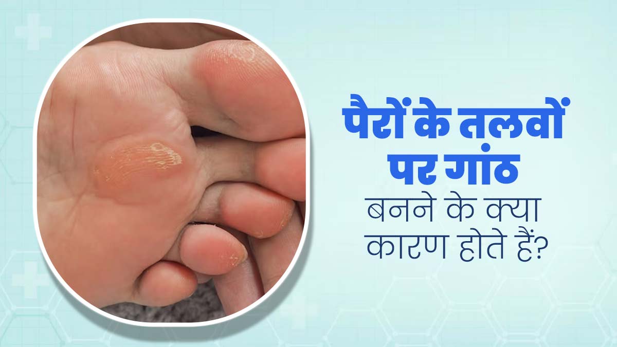 पैरों के तलवों पर गांठ क्यों बन जाती है? जानें लक्षण, कारण और बचाव के तरीके