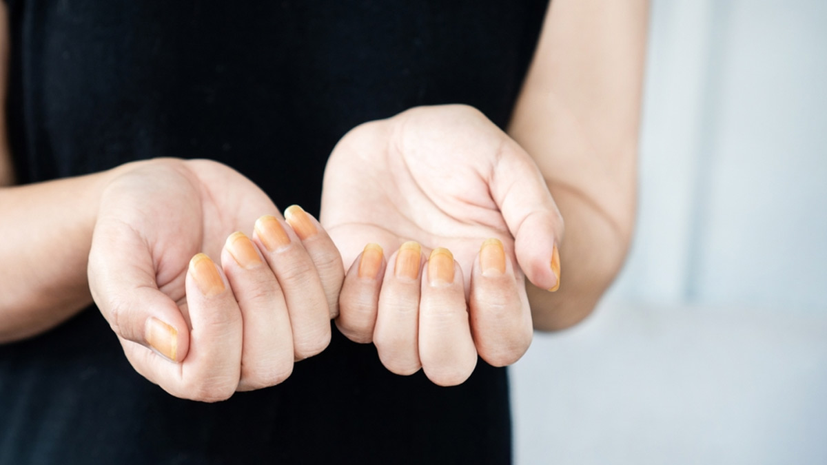 Restore Your Nail Glow: Natural Remedies For Nail Discoloration And Staining